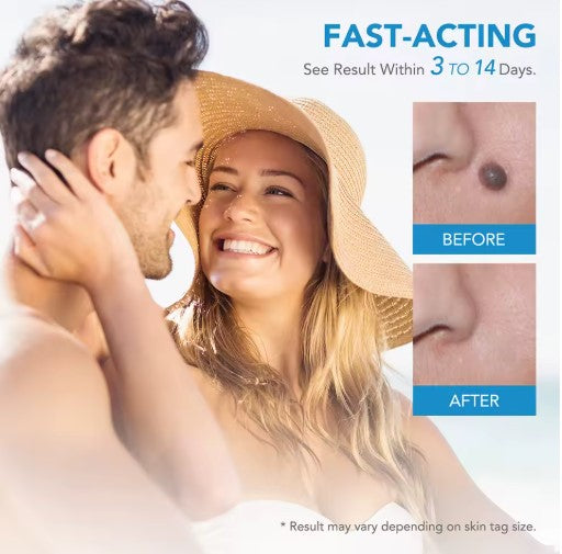SkinTag Removal Kit -  Painless Remover Kit & No More Skin Tags (Acrochordons) in Less Than 14 Days!