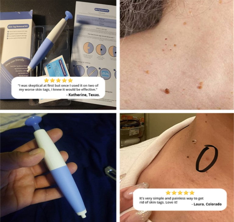 SkinTag Removal Kit -  Painless Remover Kit & No More Skin Tags (Acrochordons) in Less Than 14 Days!