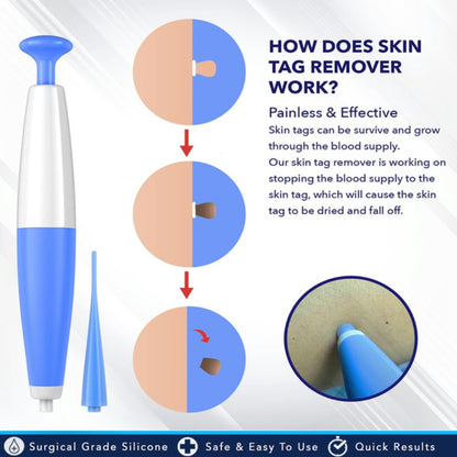 SkinTag Removal Kit -  Painless Remover Kit & No More Skin Tags (Acrochordons) in Less Than 14 Days!