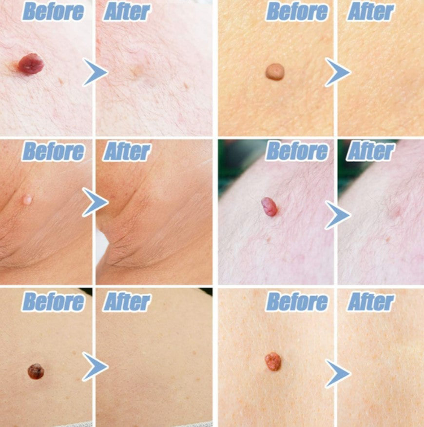 SkinTag Removal Kit -  Painless Remover Kit & No More Skin Tags (Acrochordons) in Less Than 14 Days!